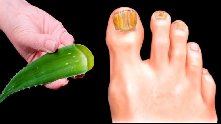 Dieser einfache Trick mit Aloe und Zitrone befreit dich zuverlässig von Nagelpilz…