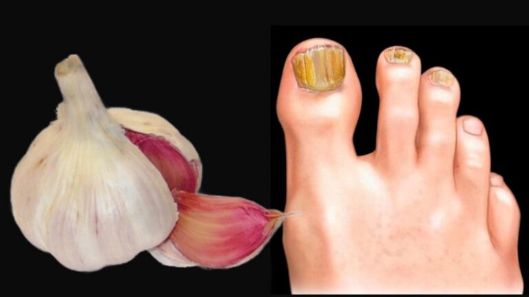 Dieser vergessene Trick beseitigt Nagelpilz im Handumdrehen – so einfach ist es…