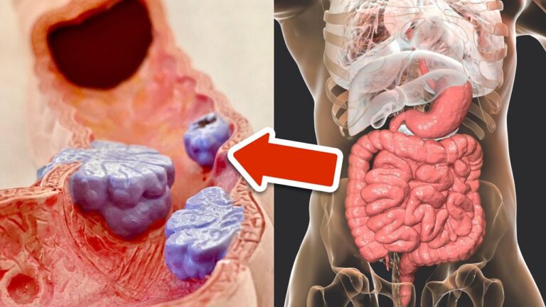 6 Wege, dein Darmkrebs Risiko sofort zu senken und gesund zu leben!