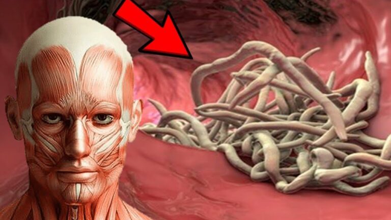 7 Anzeichen für Parasiten im Körper – Entdecke die Warnsymptome jetzt!