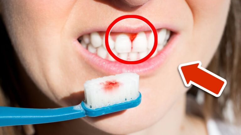 7 überraschende Gründe für Zahnfleischbluten, die du sofort wissen solltest!