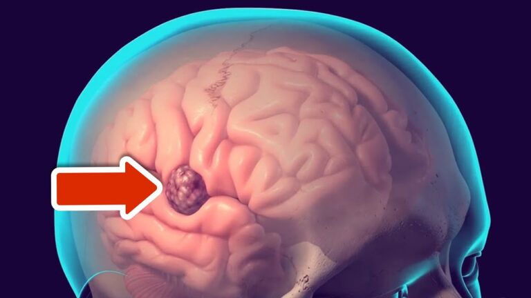 6 alarmierende Anzeichen eines Gehirntumors, die du unbedingt kennen musst!