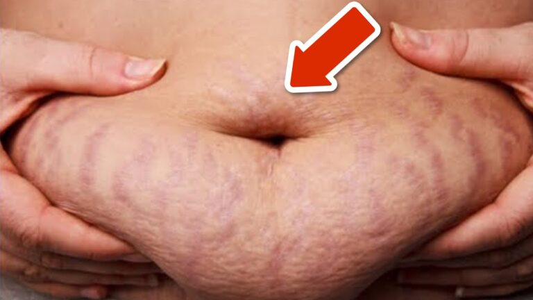 5 effektive Tipps, um Dehnungsstreifen schnell und einfach zu entfernen!